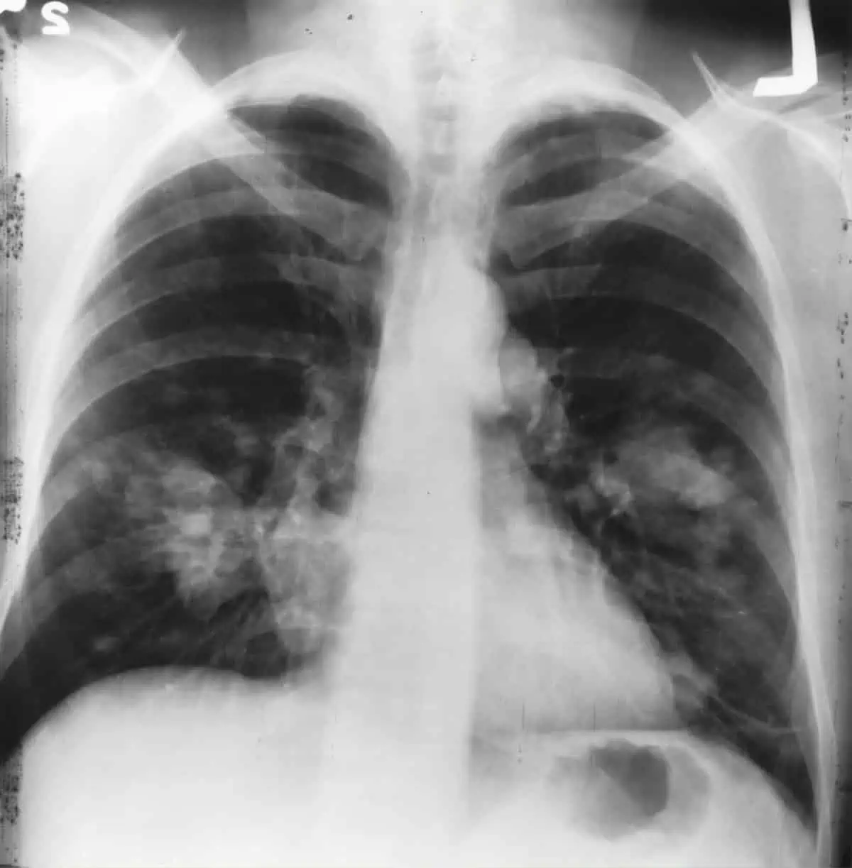 Lung Cancer Attorney